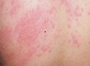 寻麻疹可以吃白瓜吗,白瓜的养生益处